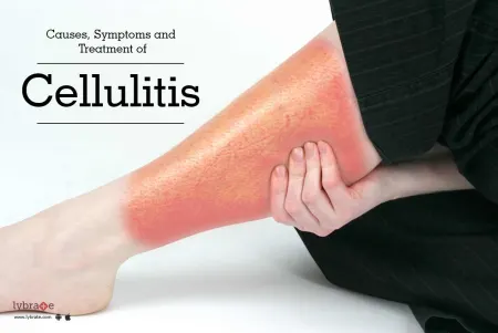 Cellulitis disease