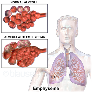 emphysema