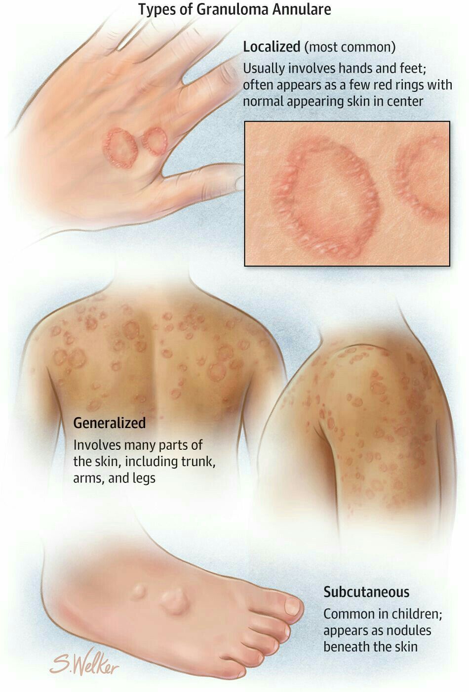 Granuloma Annulare