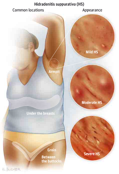 Hidradenitis suppurativa