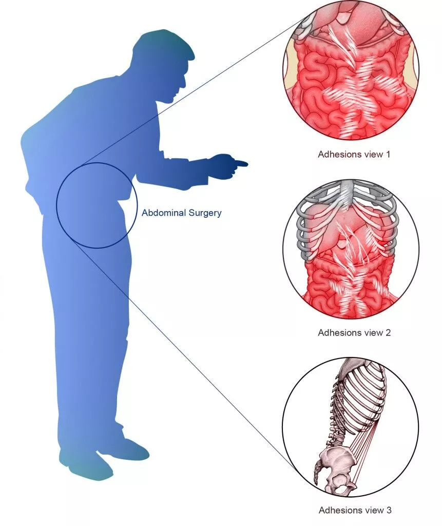 Abdominal adhesions