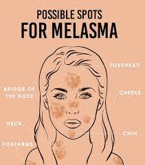 melasma