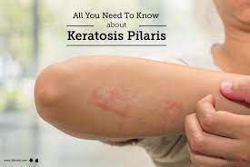 Keratosis pilaris