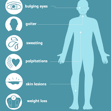 Graves’ disease