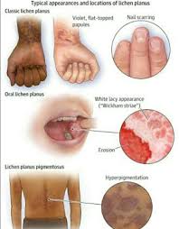Lichen planus