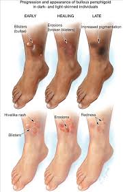 Bullous Pemphigoid