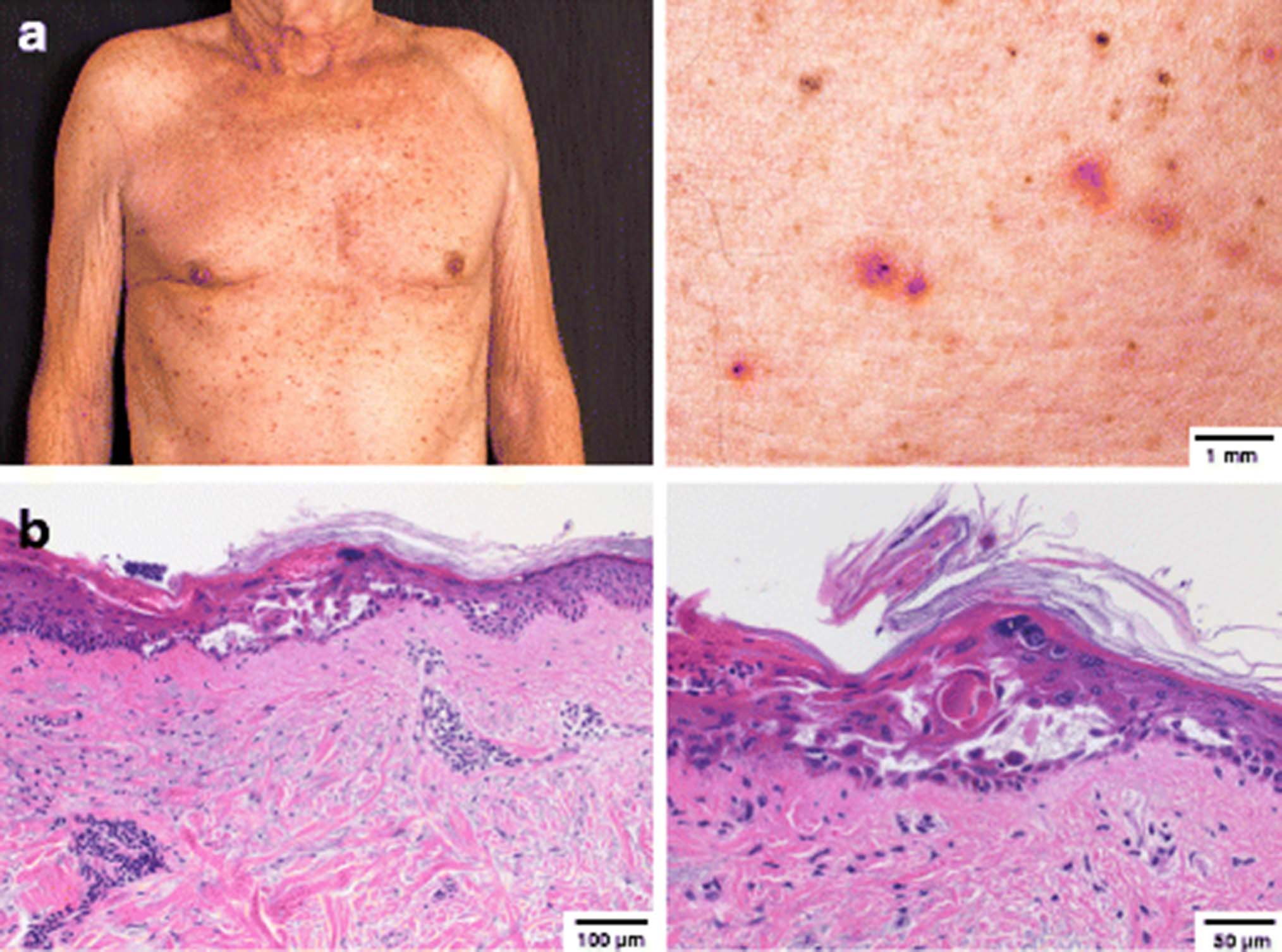 Grover’s disease