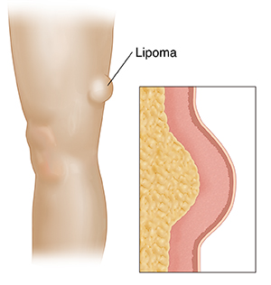 lipoma