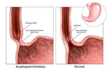 Understanding Achalasia: Causes, Symptoms, and Treatments
