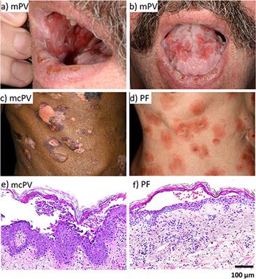 pemphigus disease