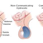 hydrocele