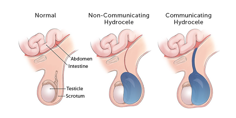 hydrocele