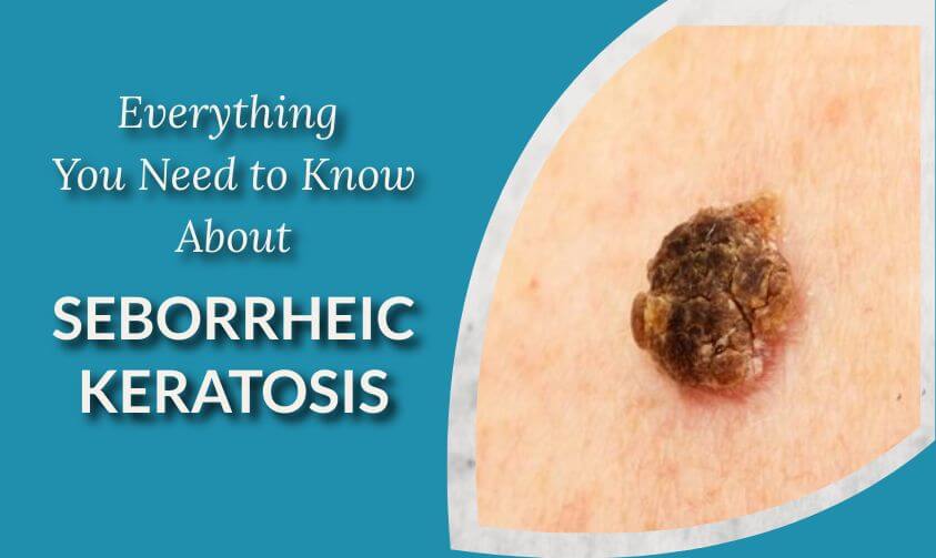 treatment for seborrheic keratosis