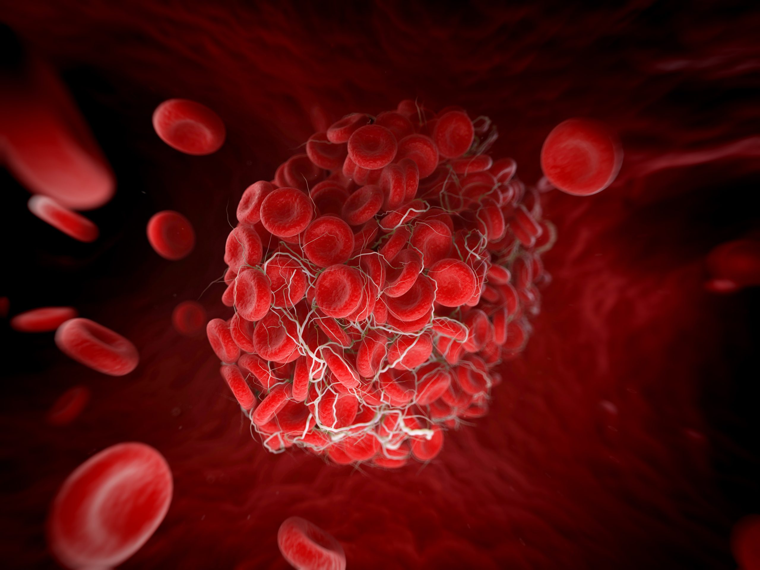Polycythemia vera treatment