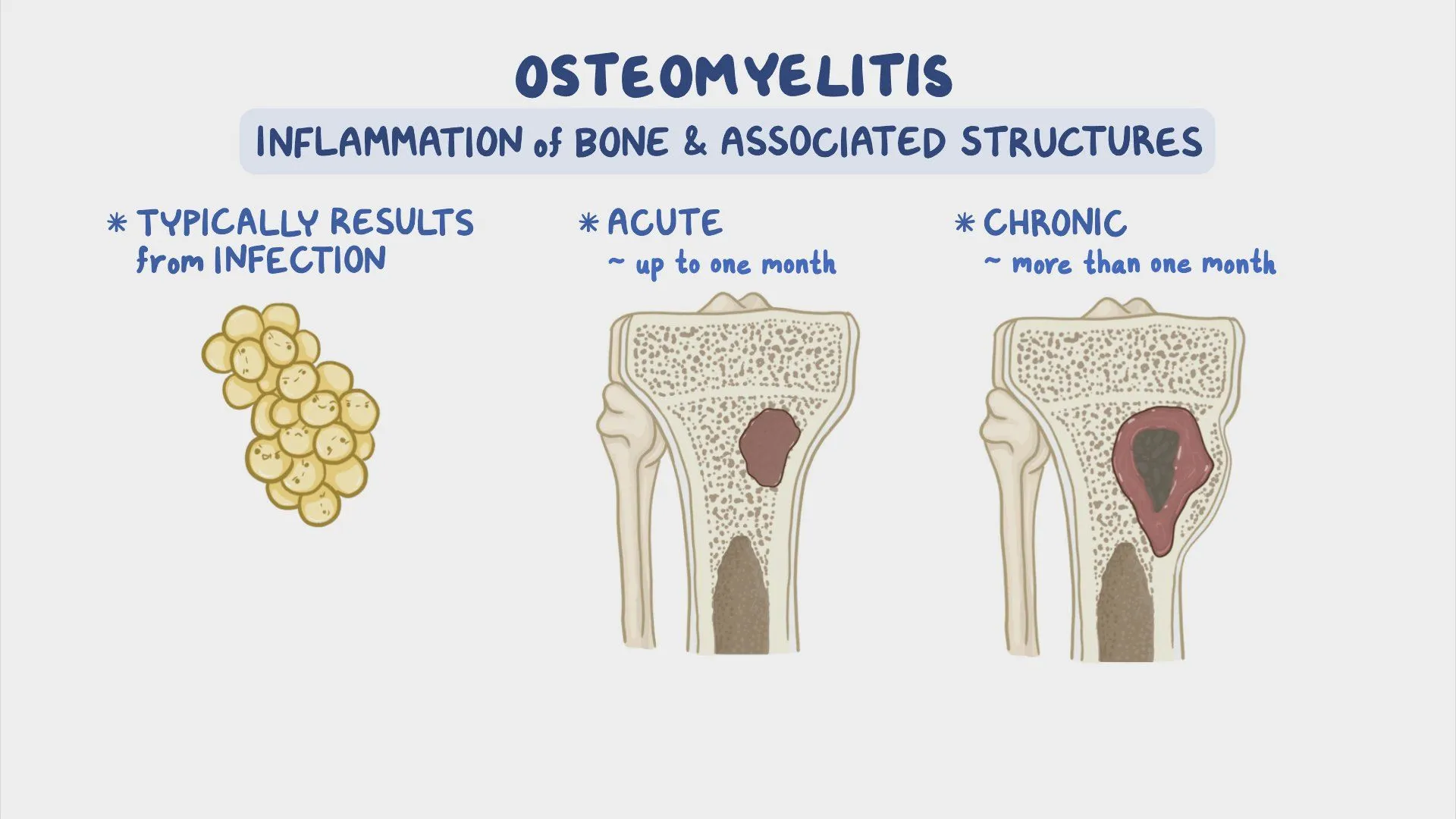 osteomyelitis