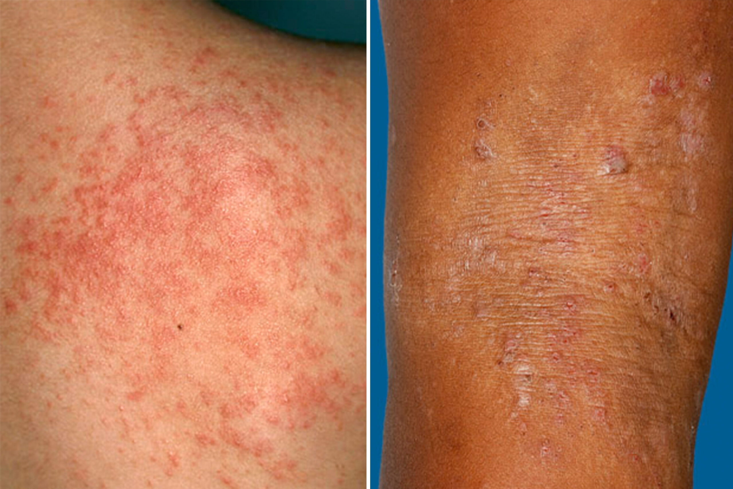 How to Keep Your Skin Cool and Rash-Free During Prickly Heat Season