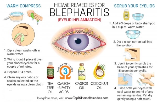 How to cure blepharitis fast