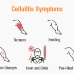 What Is Cellulitis? Symptoms, Causes, and Treatment Explained