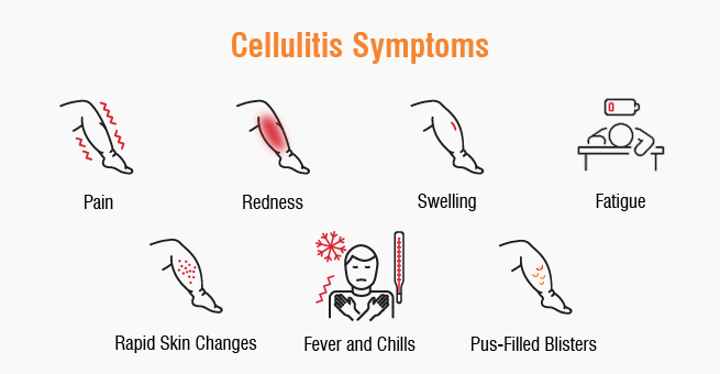 What Is Cellulitis? Symptoms, Causes, and Treatment Explained