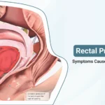 Rectal Prolapse: Causes, Symptoms, and Treatment Options Explained