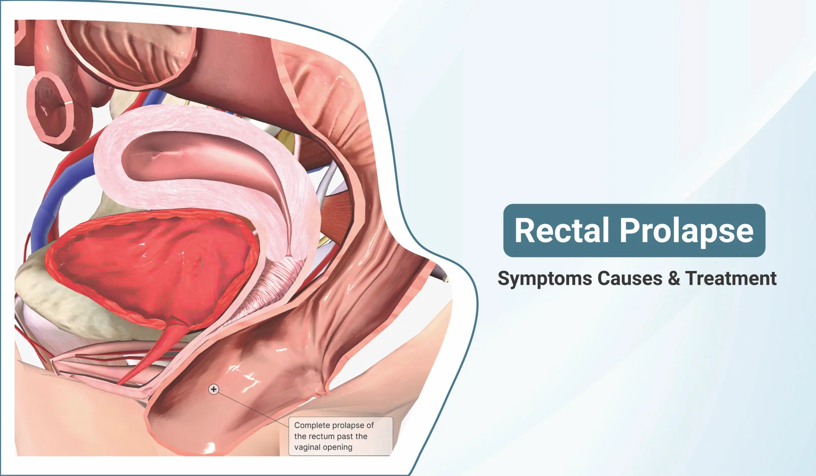 Rectal Prolapse: Causes, Symptoms, and Treatment Options Explained