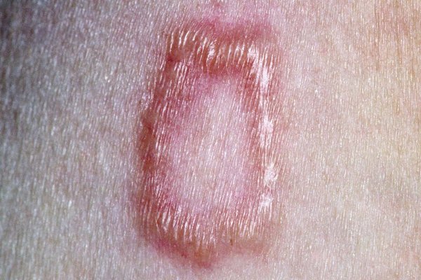 Granuloma Annulare