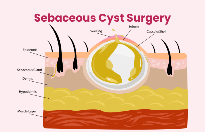 Everything You Need to Know About Sebaceous Cyst Infections