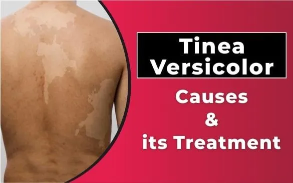 Tinea Versicolor: How to Identify and Manage This Common Skin Condition