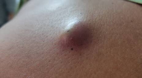 How to Treat an Infected Sebaceous Cyst at Home – Step-by-Step Guide