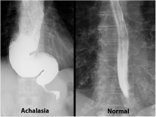 Achalasia Disease: A Complete Guide to Diagnosis and Management