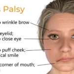 Understanding Bell's Palsy: Causes, Symptoms, and Recovery Options