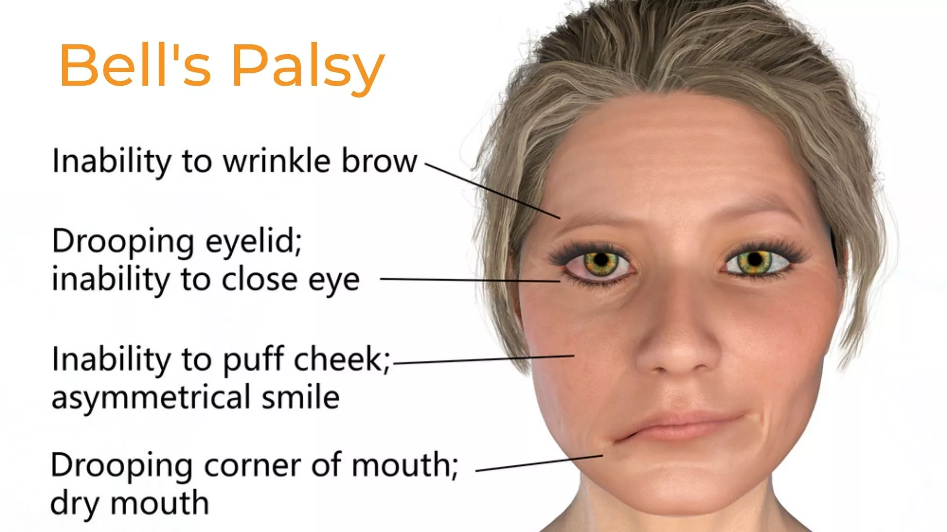 Understanding Bell's Palsy: Causes, Symptoms, and Recovery Options