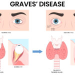 Natural Remedies and Medical Treatments for Graves' Disease