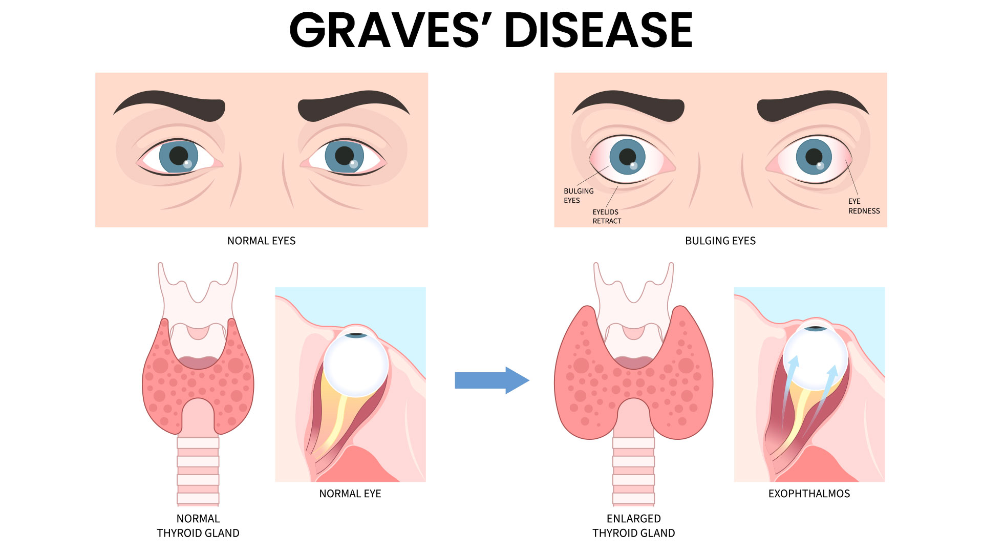 Natural Remedies and Medical Treatments for Graves' Disease
