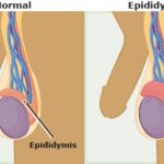 How to Treat Epididymitis Naturally and Medically