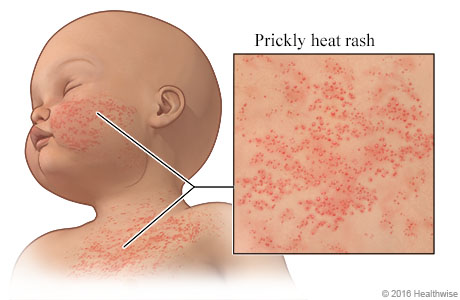 What Is Prickly Heat? Causes, Symptoms, and How to Treat It