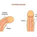 Natural Remedies for Peyronie’s Disease: Do They Really Work?