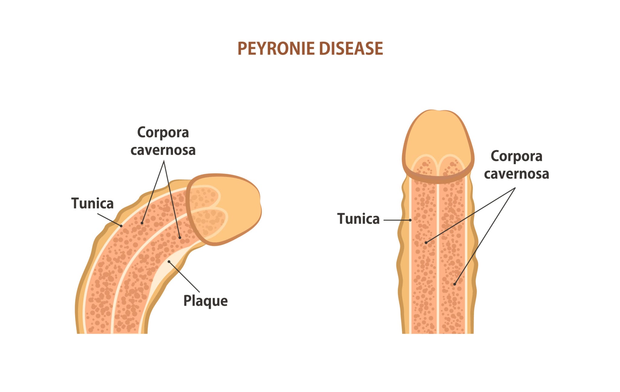 Natural Remedies for Peyronie’s Disease: Do They Really Work?