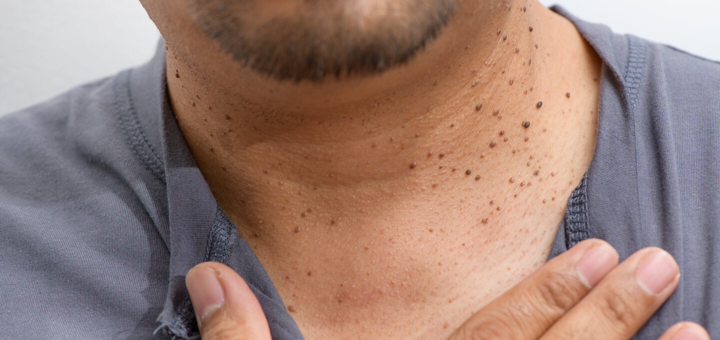How to Remove Seborrheic Keratosis at Home: A Complete Guide
