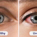 Understanding Uveitis: A Complete Guide for Eye Health
